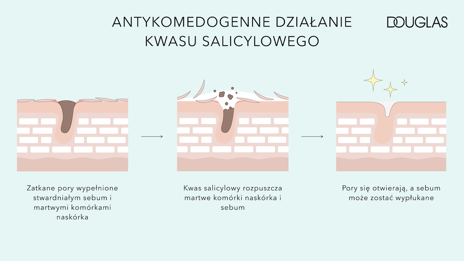 Ilustracja przedstawia działanie antykomedogenne kwasu salicylowego na skórę, pokazując proces od zablokowanych porów do ich oczyszczenia.