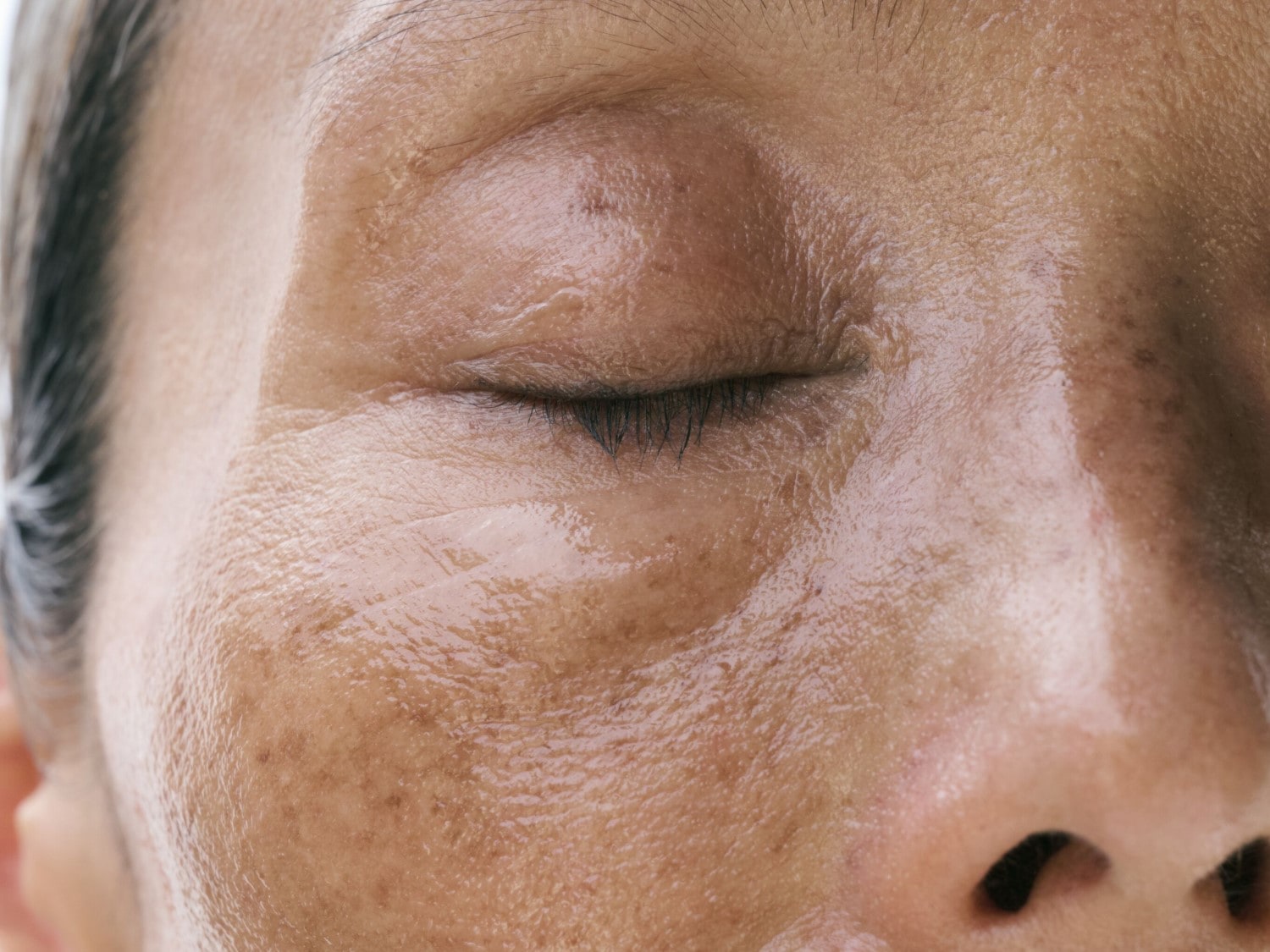 Close-up van een gezicht met een gesloten oog, de huid heeft een glanzende textuur en vertoont pigmentatie.
