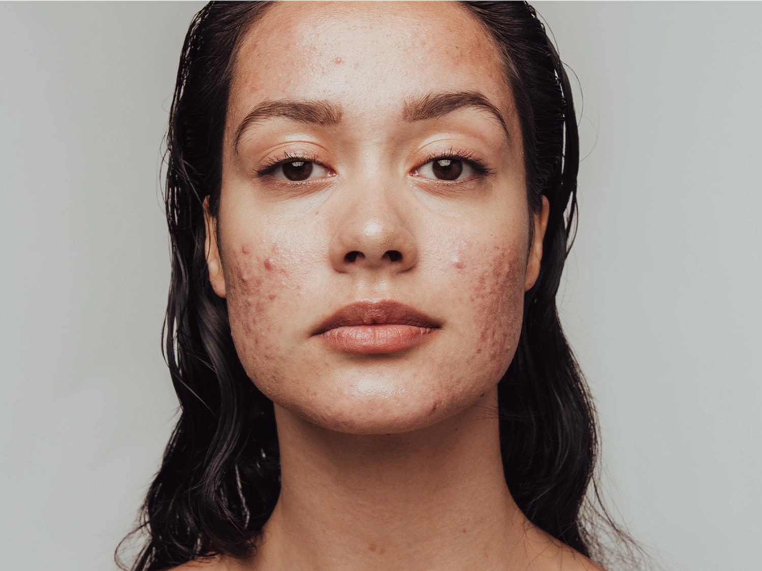 Primo piano di una donna con acne e imperfezioni cutanee, che mostra la texture e le condizioni della sua pelle.