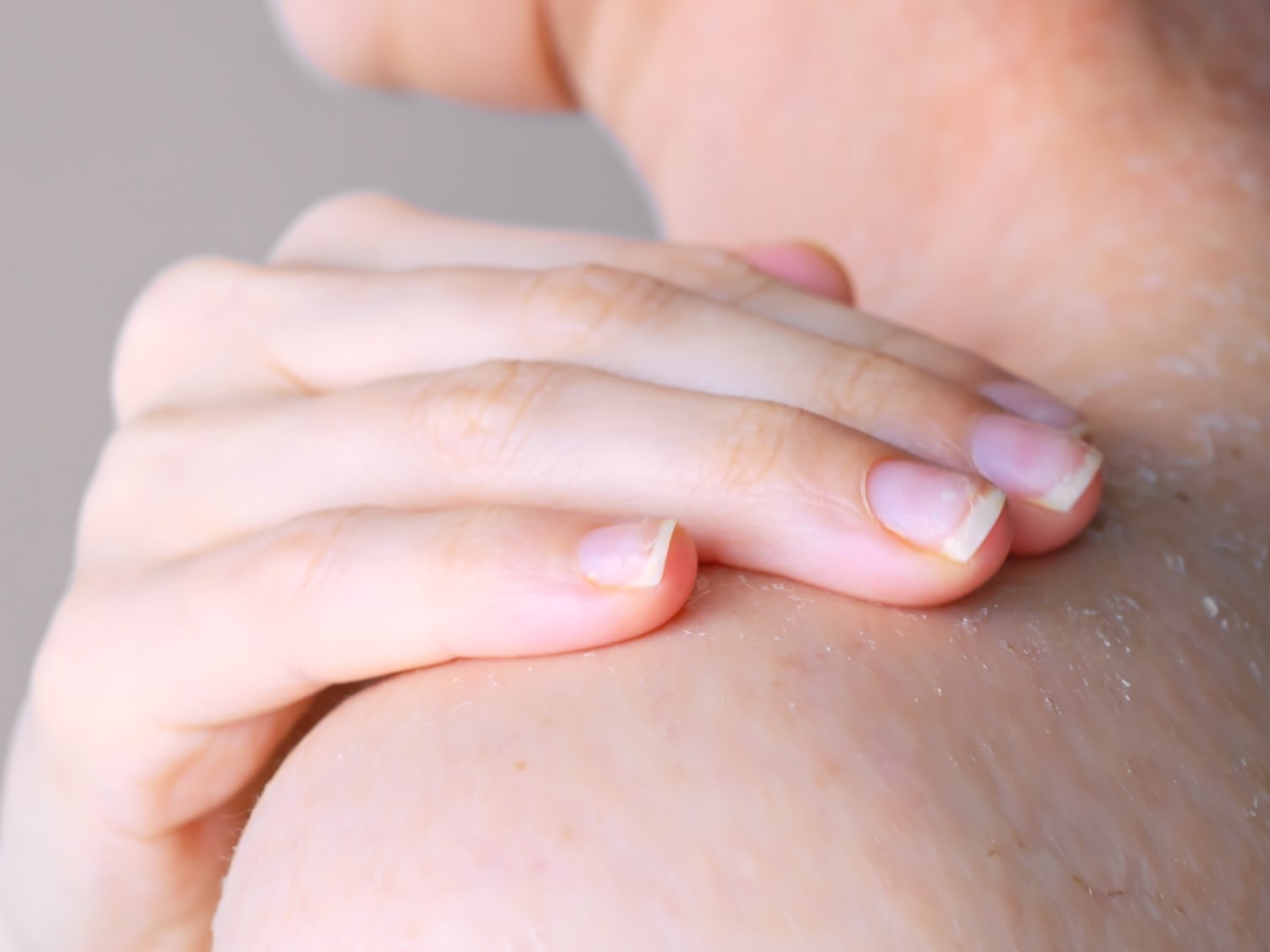 Primo piano di una mano chiara che tocca la pelle secca e squamosa sulla spalla, evidenziando la necessità di idratazione e cura.