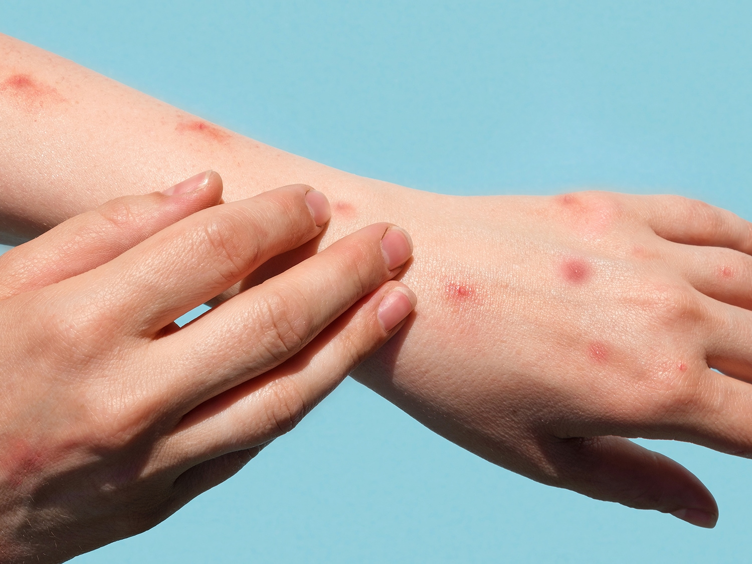 Primo piano di una mano con eruzione cutanea rossa su sfondo blu, che mostra macchie e protuberanze sulla pelle.