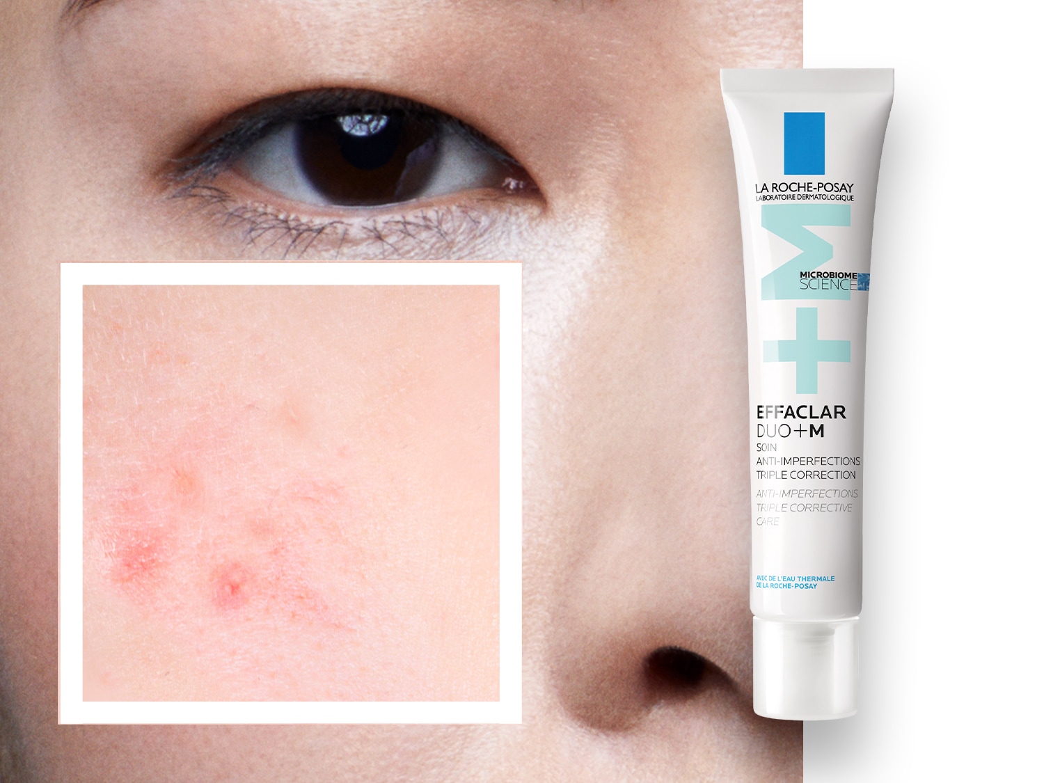 Primo piano di una donna con imperfezioni cutanee, accanto al trattamento Effaclar Duo+M di La Roche-Posay in un tubo bianco e blu, che promette una tripla azione correttiva.