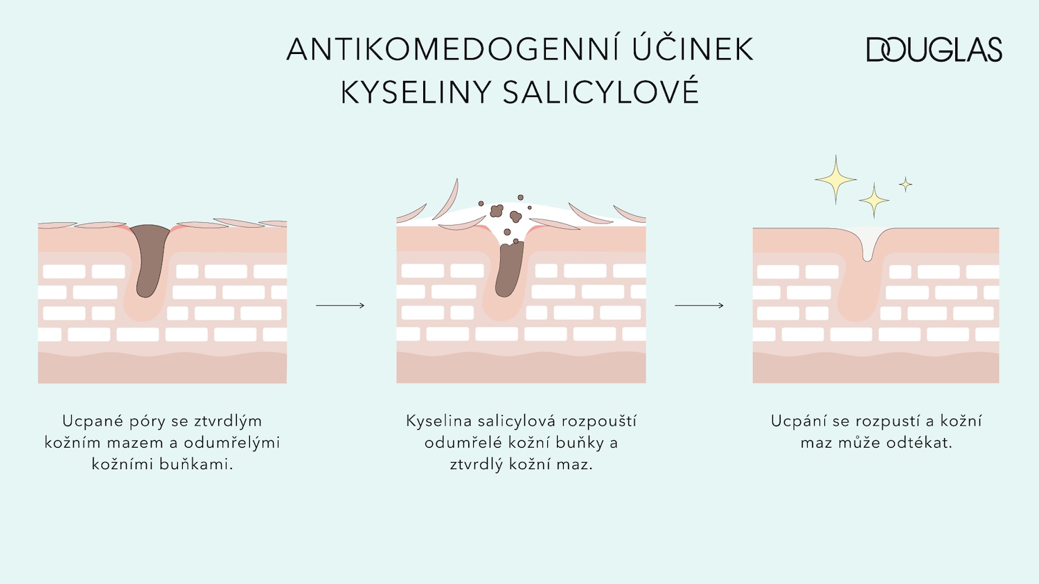 Illustration shows how salicylic acid works to clear clogged pores by dissolving dead skin cells and hardened sebum, resulting in unclogged pores and skin that can drain properly.