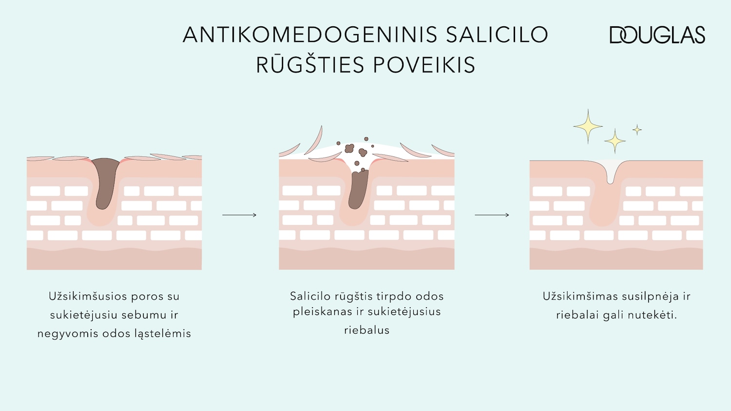 Schematic diagram illustrates how salicylic acid works to unclog pores and dissolve hardened sebum, leading to clearer skin, as presented by Douglas.