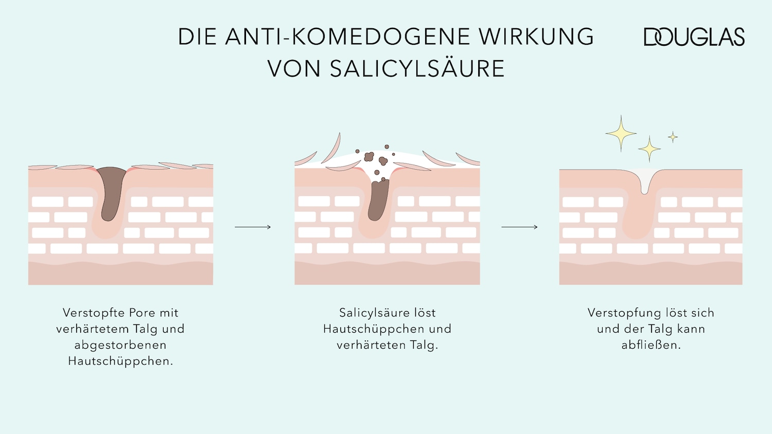Illustration showing how salicylic acid works to clear clogged pores, removing hardened sebum and dead skin cells for a clearer complexion.