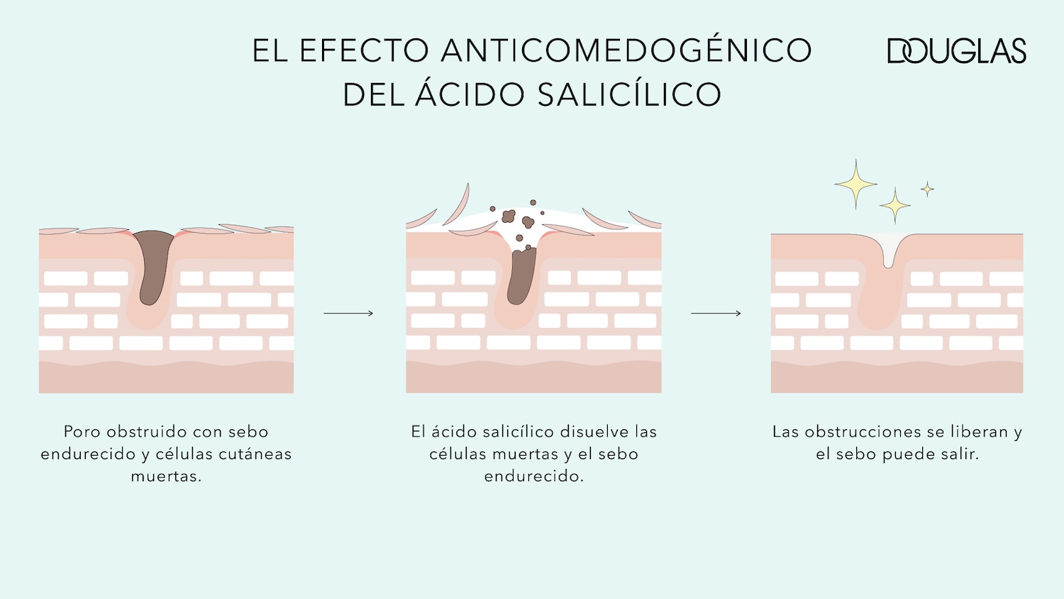 Diagram illustrates how salicylic acid clears clogged pores by dissolving dead cells and hardened sebum, leading to clearer skin.