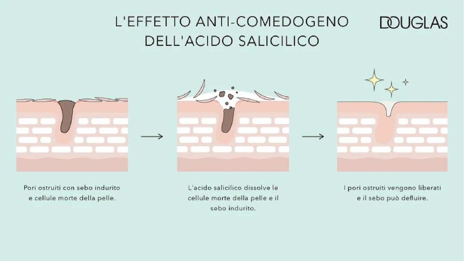 Illustrazione che mostra l'effetto anti-comedogeno dell'acido salicilico di Douglas, con pori ostruiti da sebo indurito e cellule morte della pelle.